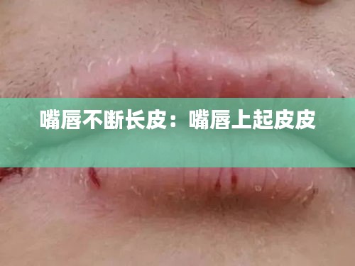 嘴唇不断长皮：嘴唇上起皮皮 