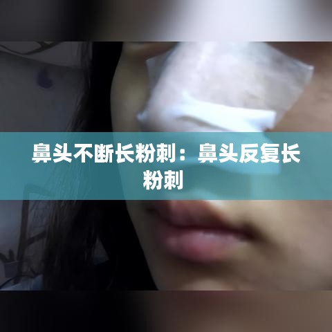 鼻头不断长粉刺：鼻头反复长粉刺 
