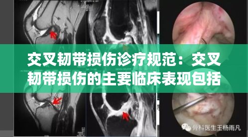 交叉韧带损伤诊疗规范：交叉韧带损伤的主要临床表现包括 