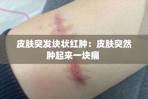 皮肤突发块状红肿：皮肤突然肿起来一块痛 
