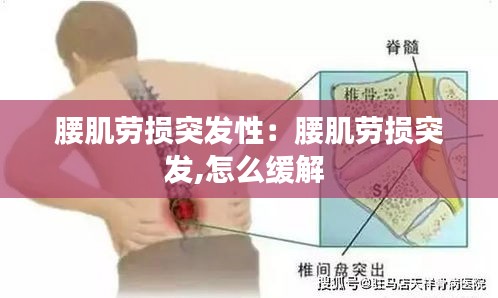 腰肌劳损突发性：腰肌劳损突发,怎么缓解 