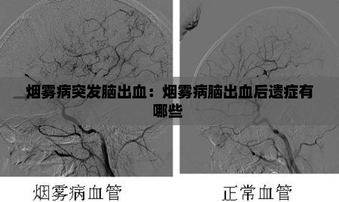 烟雾病突发脑出血：烟雾病脑出血后遗症有哪些 