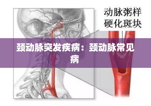 颈动脉突发疾病：颈动脉常见病 