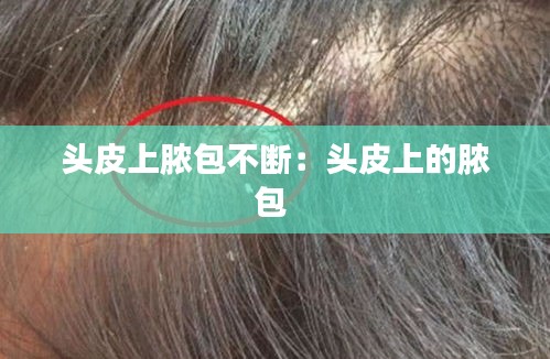头皮上脓包不断：头皮上的脓包 