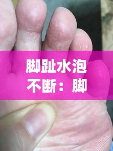 脚趾水泡不断：脚趾头上的水泡反反复复怎么办 