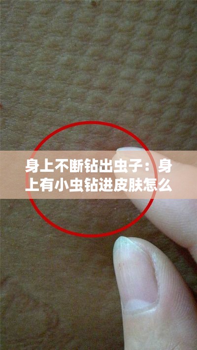 身上不断钻出虫子：身上有小虫钻进皮肤怎么办 