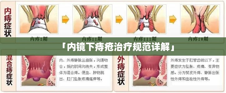 「内镜下痔疮治疗规范详解」