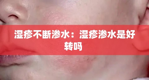 湿疹不断渗水：湿疹渗水是好转吗 