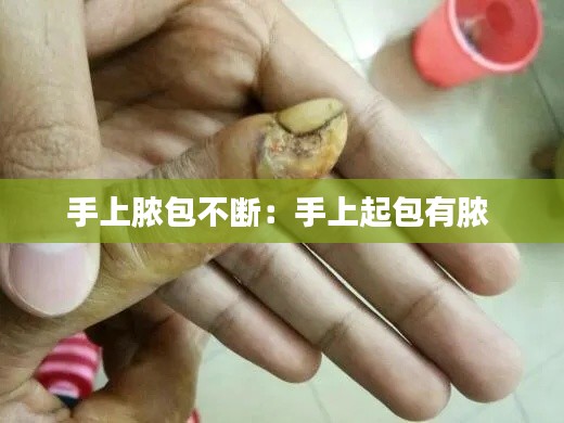 手上脓包不断：手上起包有脓 