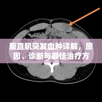 腹直肌突发血肿详解，原因、诊断与最佳治疗方案
